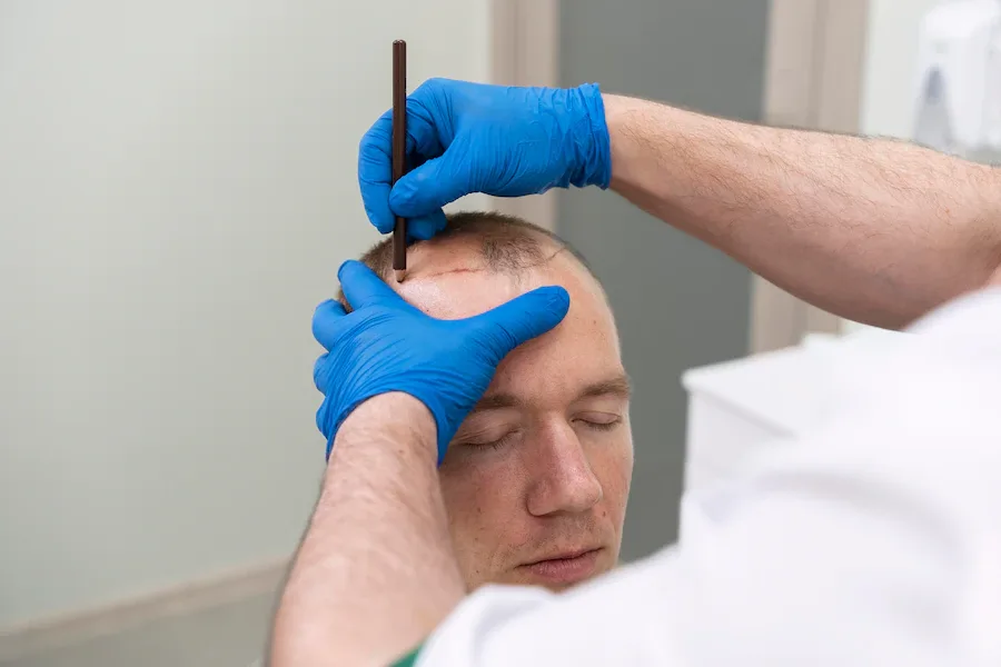 Alopecia Areata - czy przeszczep włosów jest możliwy?