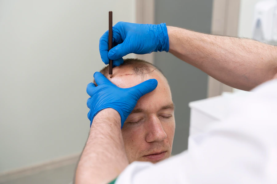 Alopecia Areata - czy przeszczep włosów jest możliwy?