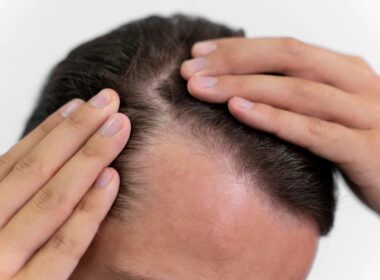 Na co należy uważać po przeszczepie włosów?